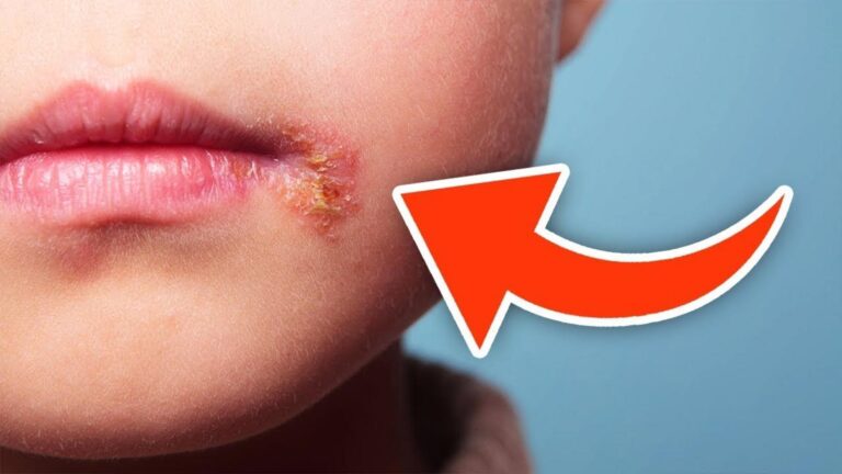 Cette méthode naturelle vous débarrasse définitivement des boutons de fièvre…