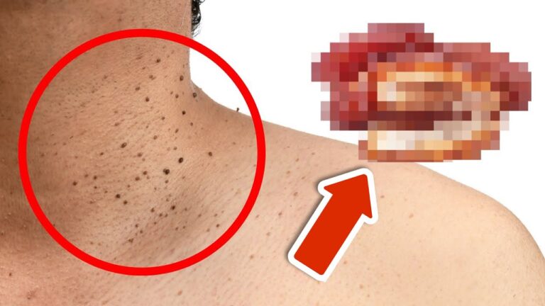 5 aliments surprenants qui causent des peau d’ange à éviter absolument !