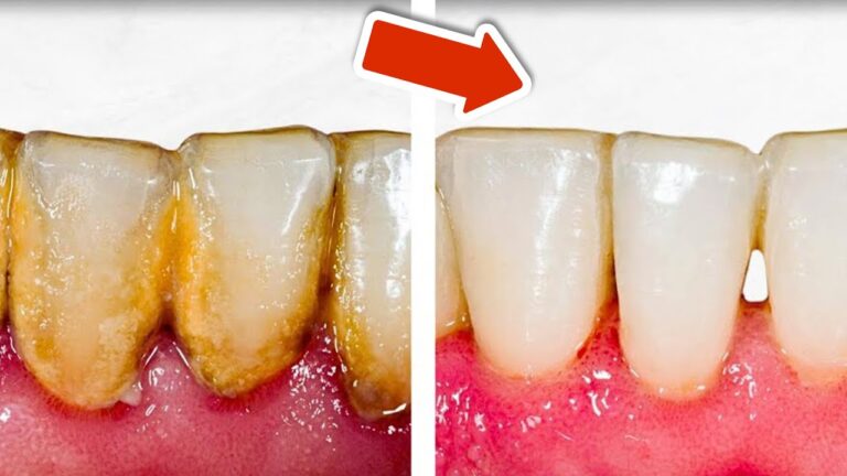 Éliminez votre plaque dentaire en 7 jours avec ces astuces surprenantes !