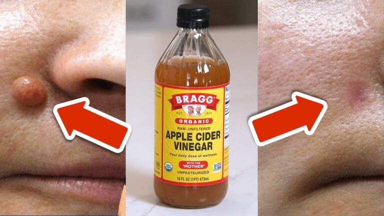 Retrouvez 7 astuces pour éliminer les verrues avec du vinaigre de cidre en 24h !