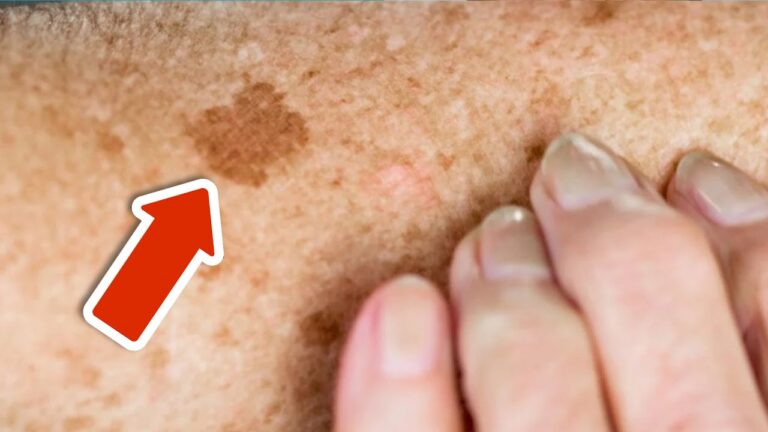 Ce vitamin miracle : 5 étapes pour éliminer les taches de vieillesse définitivement !