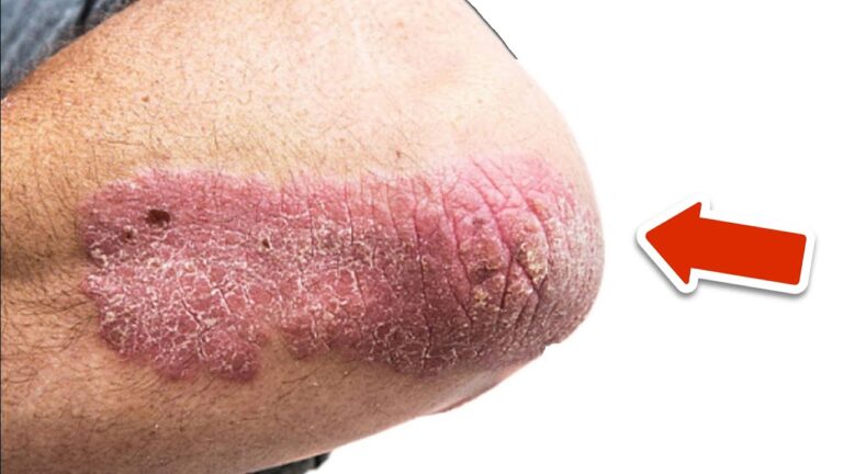 Découvrez 5 Vitamines efficaces pour éliminer définitivement le psoriasis !