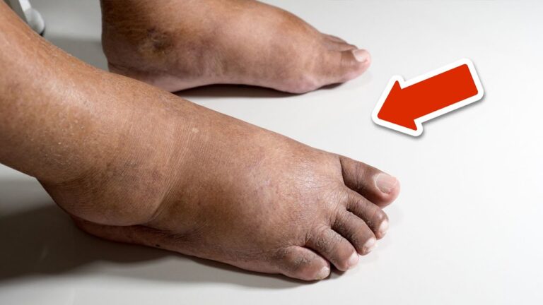 5 Vitamines Essentielles pour Éliminer les Gonflements des Pieds et Jambes !