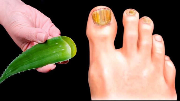Éliminez le champignon des ongles en 3 étapes avec l&rsquo;aloe vera efficace !