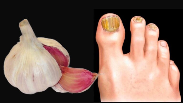 Éliminez le champignon des ongles avec ce remède naturel en 5 étapes faciles !