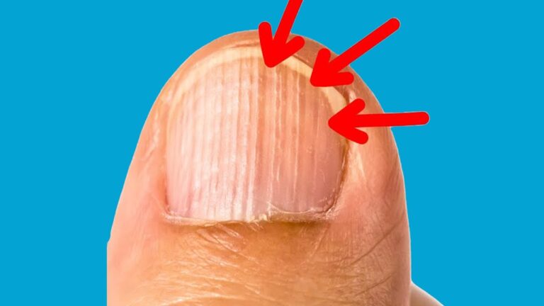 5 astuces pour comprendre les lignes verticales sur vos ongles et améliorer leur santé